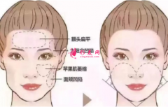 自體脂肪填充臉部有什么好處？