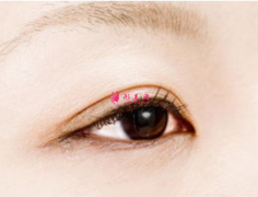 切開(kāi)雙眼皮和埋線雙眼皮有什么區(qū)別？