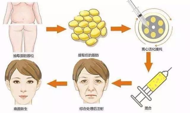 關(guān)于自體脂肪填充的干貨 請(qǐng)務(wù)必收好 張清峰