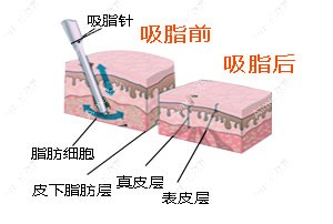 抽脂前后對(duì)比 抽脂前后對(duì)比