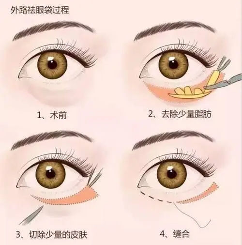 做雙眼皮后眼睛腫了怎么辦？如何使用疤克?