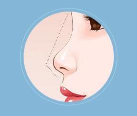 隆鼻手術(shù)的原理是什么