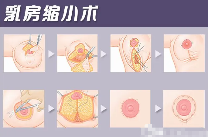 多大可以做乳房縮小手術(shù)，哪些情況適合做乳房縮小手術(shù)?