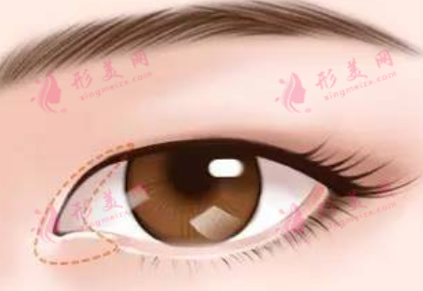 內(nèi)眼角開太大了怎么辦？如何二次修復(fù)？