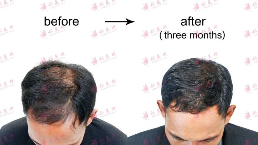如何治療脫發(fā)?有沒(méi)有什么小偏方?