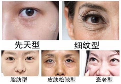 上海九院常見消除眼袋的方法有哪些?