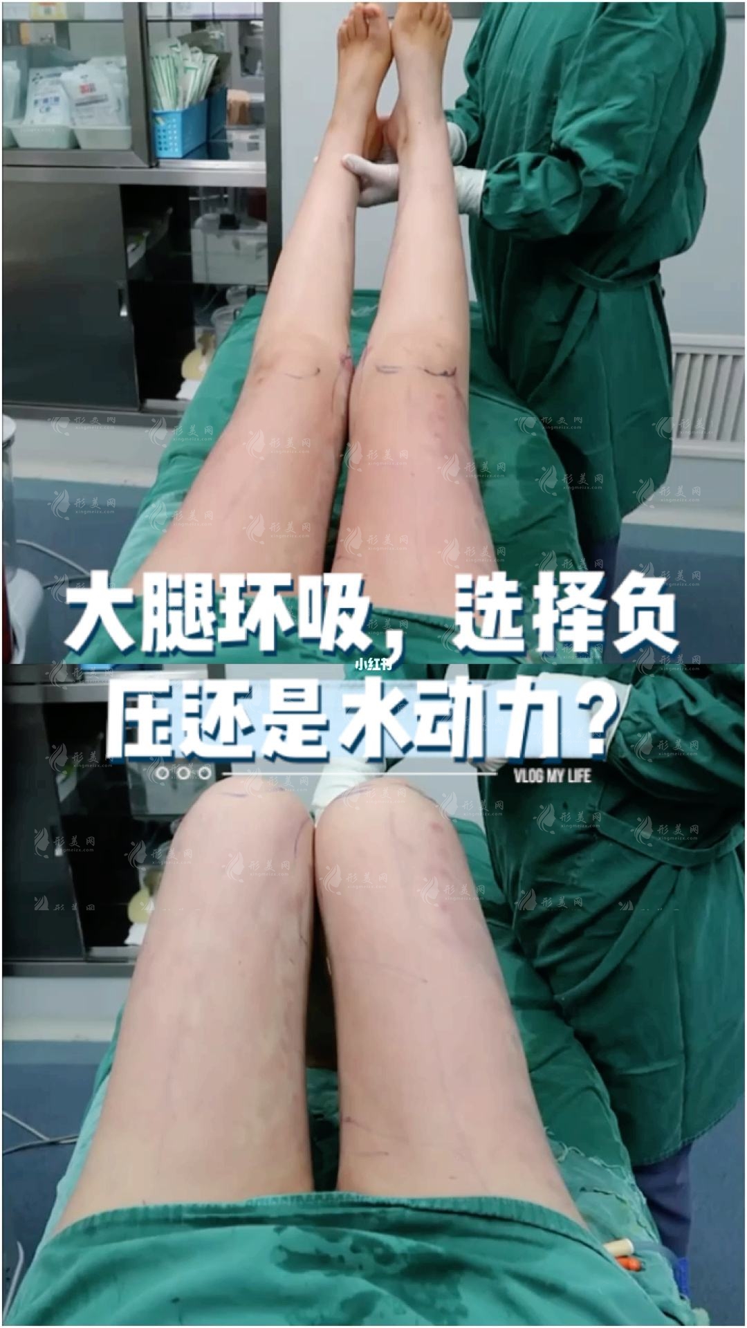 水動(dòng)力吸脂手術(shù)收費(fèi)價(jià)格貴嗎? 水動(dòng)力吸脂手術(shù)收費(fèi)價(jià)格貴嗎?