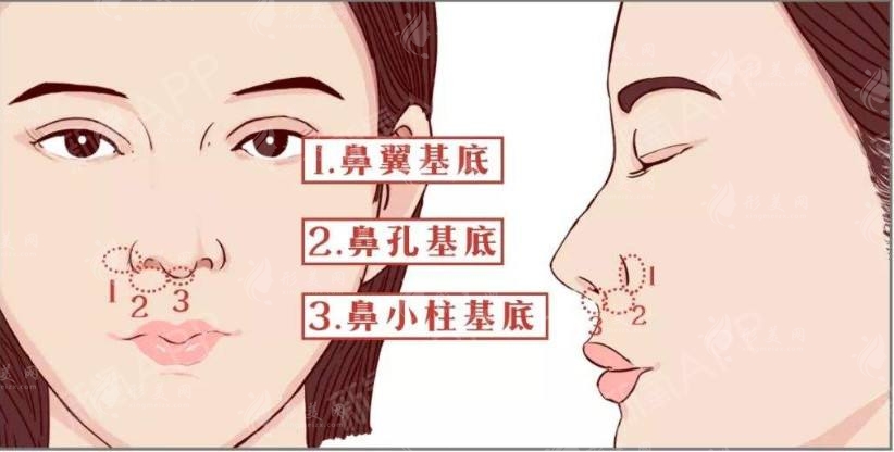 墊鼻基底的適應(yīng)癥狀有哪些？危害有哪些？