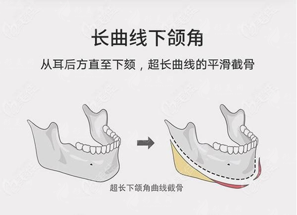 圣嘉新張笑天輪廓科普:下頜角手術(shù)磨骨好還是削骨好呢 圣嘉新張笑天輪廓科普:下頜角手術(shù)磨骨好還是削骨好呢