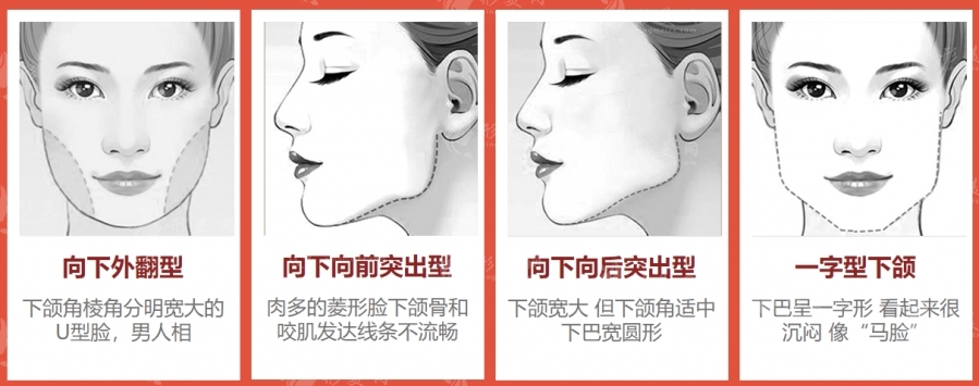 圣嘉新張笑天輪廓科普:下頜角手術(shù)磨骨好還是削骨好呢 圣嘉新張笑天輪廓科普:下頜角手術(shù)磨骨好還是削骨好呢