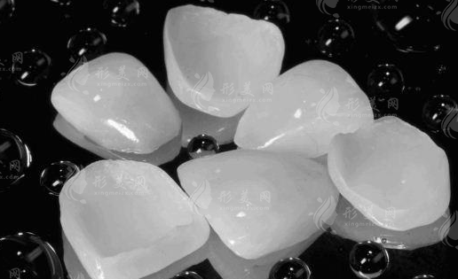 牙齒貼面的費(fèi)用貴不貴呀? 牙齒貼面的費(fèi)用貴不貴呀?