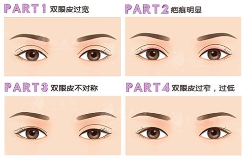 雙眼皮修復(fù)術(shù)后要注意什么？