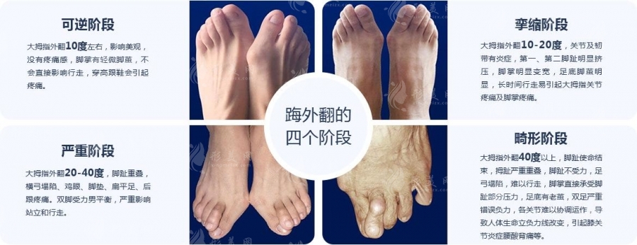 拇外翻微創(chuàng)手術(shù) 拇外翻微創(chuàng)手術(shù)