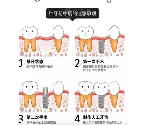 北京種植牙價(jià)格一覽表2023-費(fèi)用影響因素-注意事項(xiàng) 北京種植牙價(jià)格一覽表2023-費(fèi)用影響因素-注意事項(xiàng)