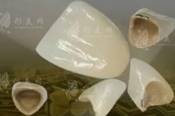 烤瓷牙價(jià)格和種類(lèi)有哪些？哪種效果比較好？科普知識(shí)一覽