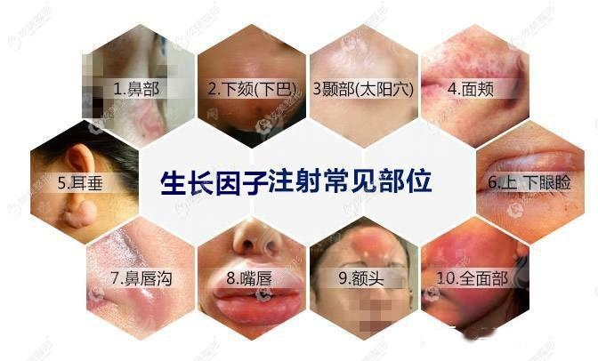生長因子注射常見部位