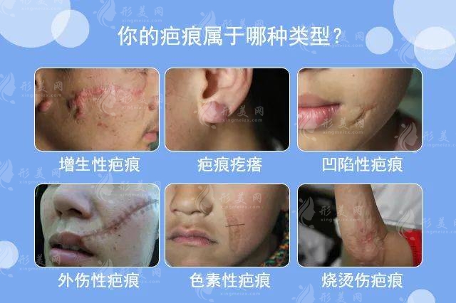 四川友誼醫(yī)院疤痕科效果好不好？去疤效果好醫(yī)生超級(jí)有名