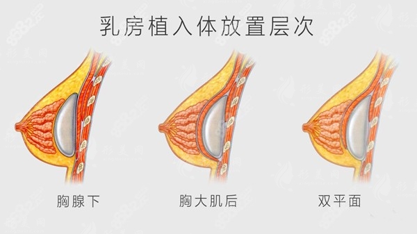 揭曉南京夏建軍和黃名斗哪個(gè)技術(shù)好？假體隆胸參考價(jià)格優(yōu)勢(shì)在線預(yù)約！