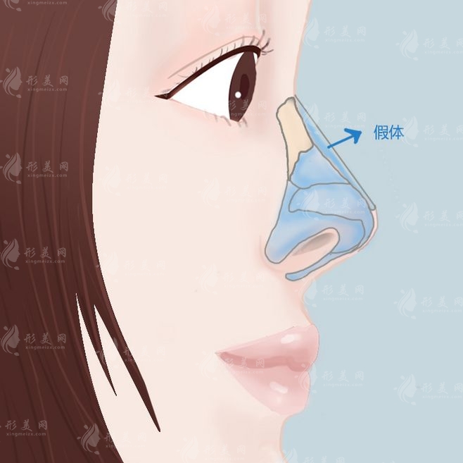 假體隆鼻手術