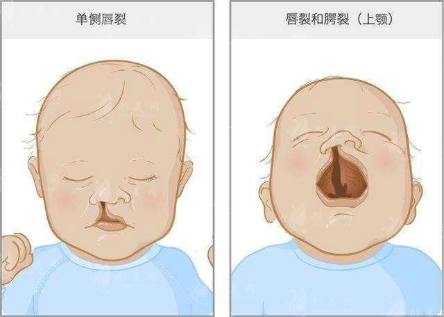 兔唇會遺傳嗎 兔唇會遺傳嗎