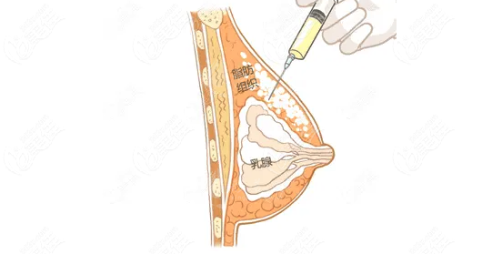 上海九醫(yī)院自體脂肪隆胸價格一般多少錢？豐胸醫(yī)生及價格參考