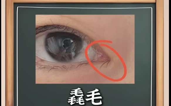 內(nèi)眼角的毳毛是什么，上海愛尚麗格的專業(yè)建議