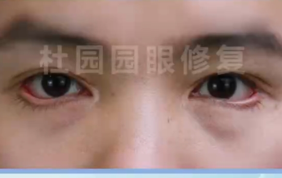 杜園園醫(yī)生的外眼角失敗修復案例分享