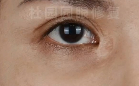 杜園園醫(yī)生內眼角片狀疤痕修復，有問題的小伙伴可以參考下喲~