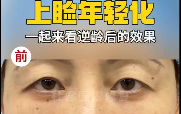 眼窩塌陷，上瞼皮膚松弛？杜園園醫(yī)生上瞼年輕化一起來看看