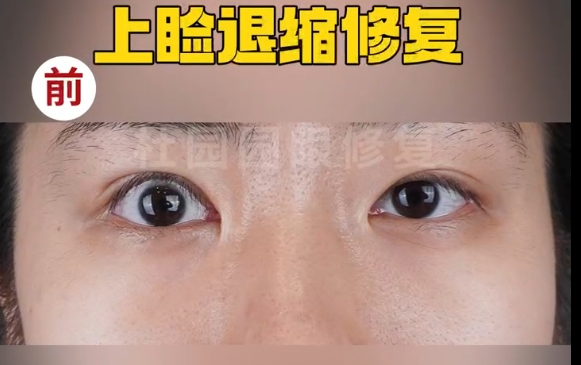 上瞼下垂失敗不再困擾！上海愛尚麗格專家?guī)鷮ふ医鉀Q方案