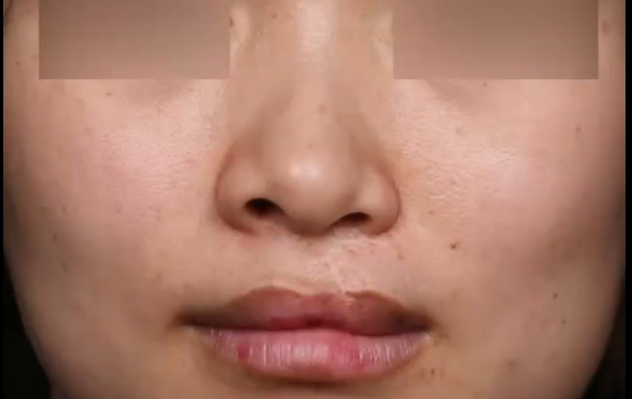 余文林醫(yī)生：重塑美麗，告別左側(cè)唇裂和鼻子輕微畸形