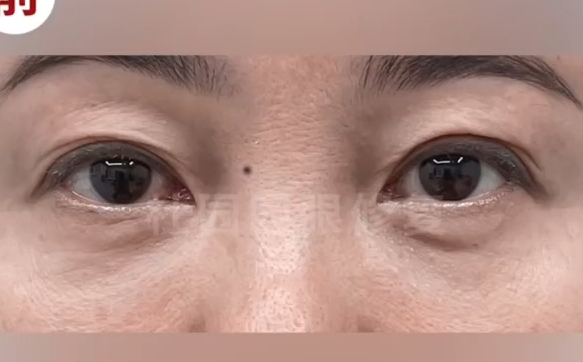 重塑雙眼魅力，上海愛尚麗格醫(yī)院雙眼皮多重褶皺修復解決方案