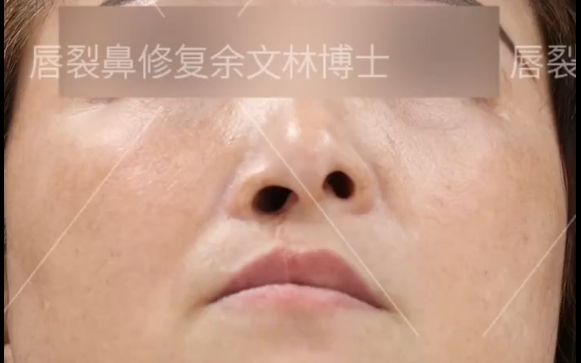 唇裂修復(fù)后，鼻子為什么還是歪的？余文林醫(yī)生詳解
