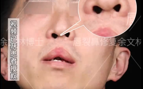 如何解決雙側(cè)唇裂問題？余文林醫(yī)生案例分享，擺脫?dān)椬彀愕拇叫?></a><p class=