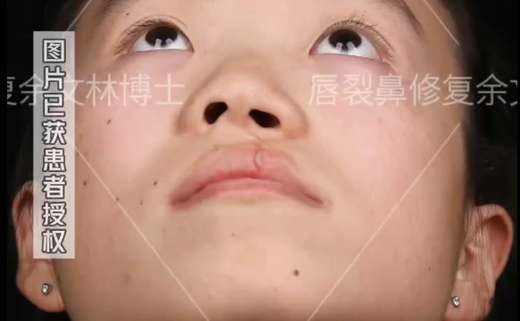 余文林醫(yī)生揭秘：小時候的唇裂沒修復(fù)好會變成怎么樣？