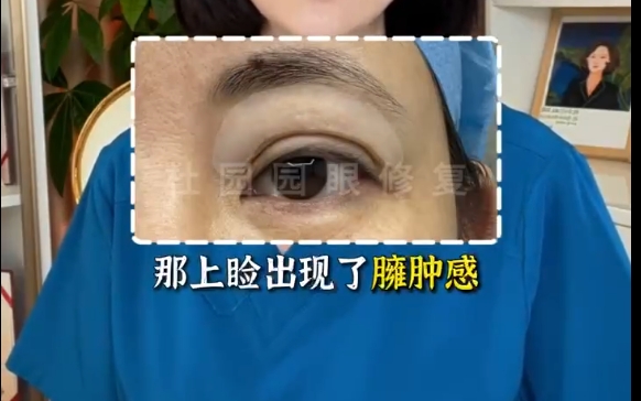 揭秘上眼瞼脂肪注射不滿意的真相！上海愛尚麗格專家解答你為什么
