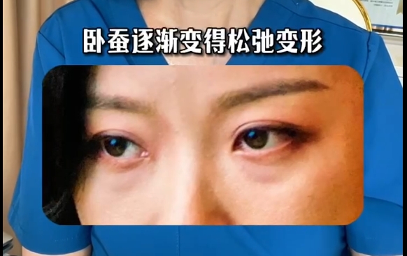 臥蠶變形松弛如何恢復(fù)青春？杜園園醫(yī)生帶你重拾年輕，恢復(fù)自信！