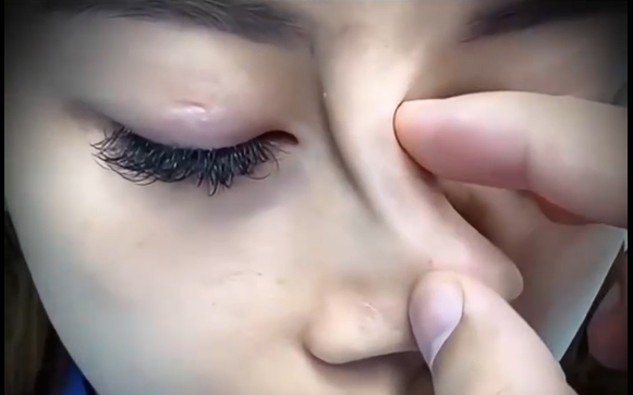 魏皎醫(yī)生解答：隆鼻后假體會(huì)不會(huì)出現(xiàn)移位問題 