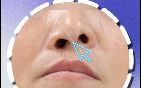 患側(cè)vs健側(cè)鼻孔大，哪種更好修復(fù)？余文林醫(yī)生分析