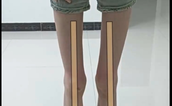 程辰醫(yī)生揭秘：酒杯腿與筷子腿，如何選擇？ 