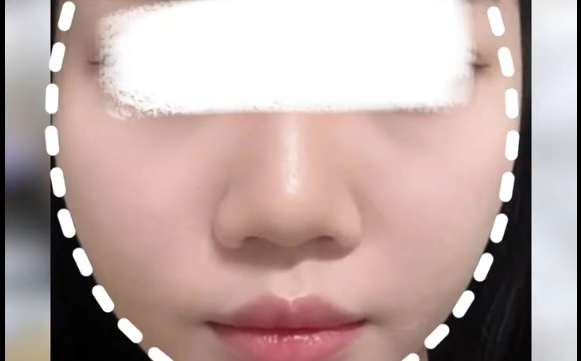普通女孩做面部吸脂，奉勸先了解好這些！
