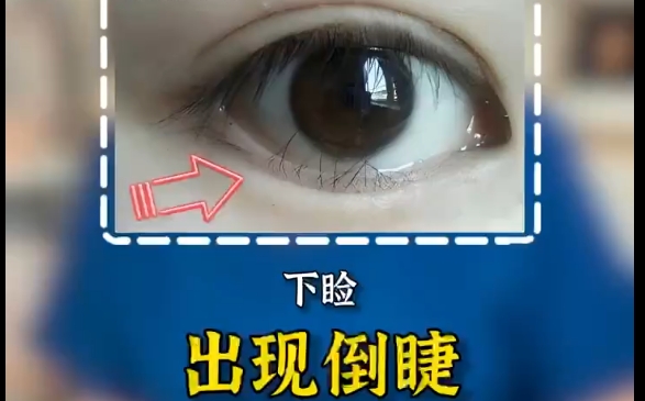 為何做完外眼角下至?xí)a(chǎn)生倒睫現(xiàn)象？上海愛尚麗格專家解答