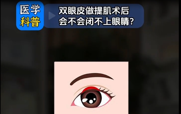 雙眼皮做提肌術(shù)后真的會閉不上眼？專家杜園園醫(yī)生解答 