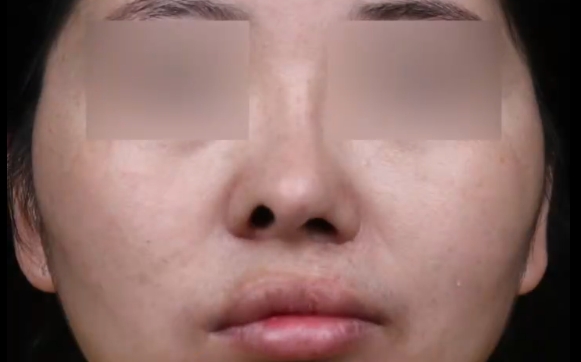 唇裂鼻放膨體后期形狀是否會(huì)改變？余文林醫(yī)生給出解答！