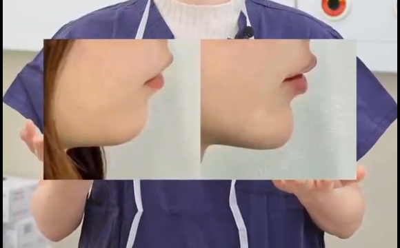 如何改善下巴后縮問題，讓你的面部線條更加完美 