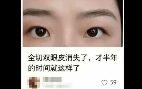 雙眼皮術(shù)后：近期效果 vs. 遠(yuǎn)期效果，杜園園醫(yī)生解析