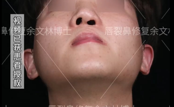 唇裂修復(fù)后的秘密：為什么要戴鼻撐？余文林醫(yī)生解答