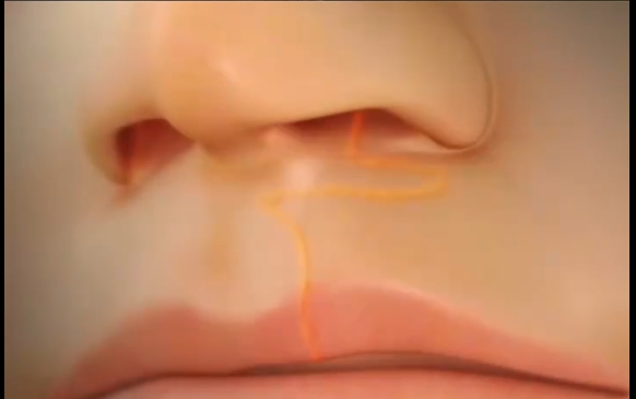 發(fā)現(xiàn)孩子唇裂？不要慌！余文林醫(yī)生的專業(yè)解答 