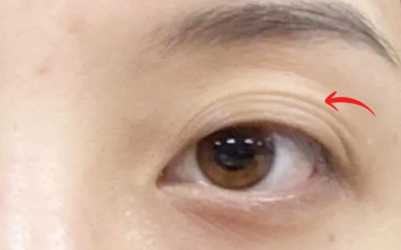 周顯玉醫(yī)生解析：多層雙眼皮提眉為何效果不佳？ 