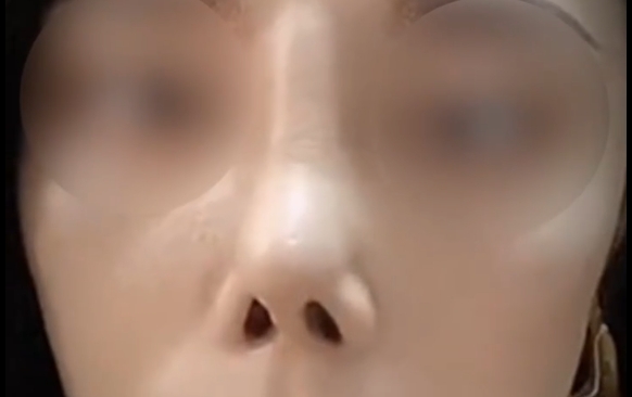 為什么隆鼻手術(shù)的翻車率居高不下？揭秘這幾個細(xì)節(jié)你必須知道！